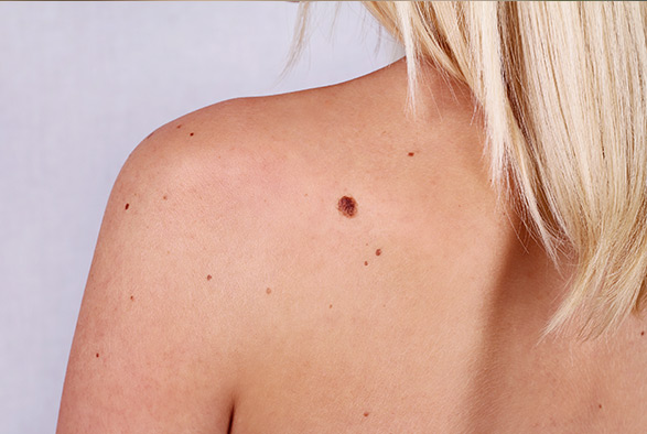 Lead image for OPDIVO + YERVOY PBS-listed for treatment of early metastatic melanoma recurrence
