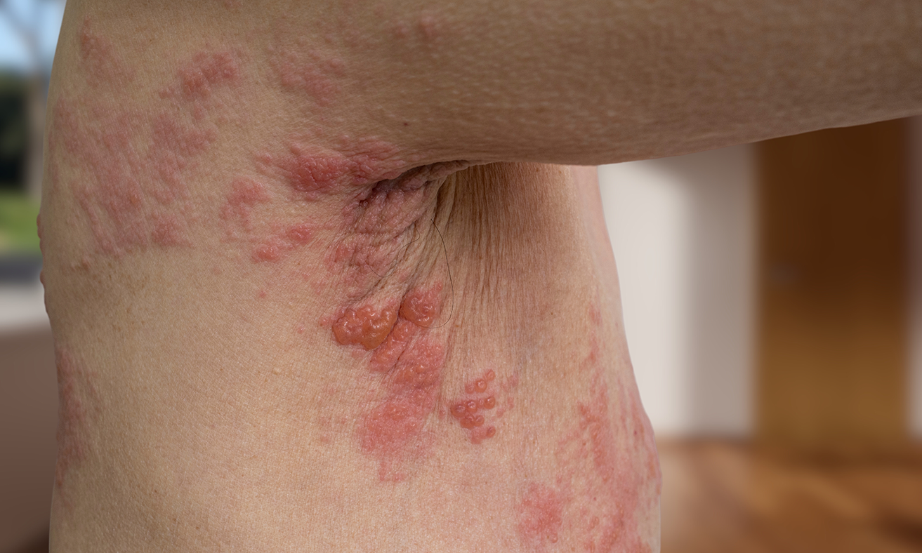 shingles2.png