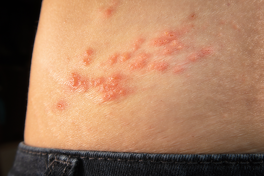 shingles1.png
