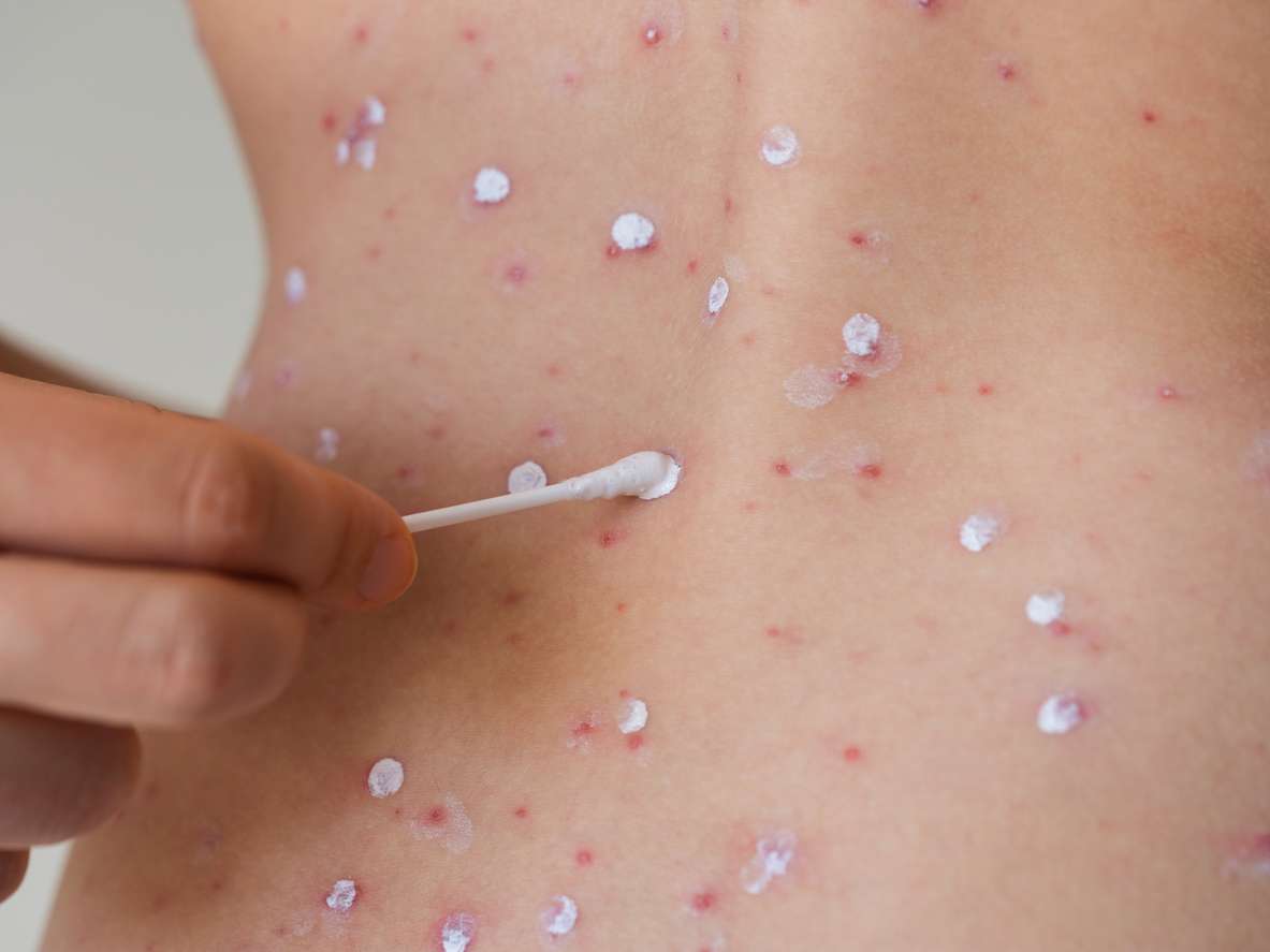 Lead image for Shingles in brief: Recognition, management, and the role of pharmacists