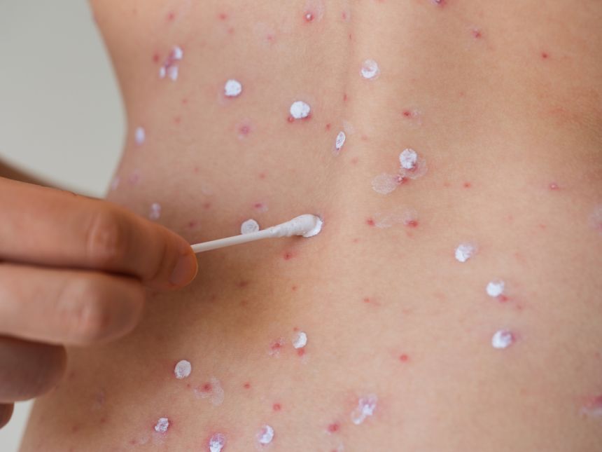Shingles in brief: Recognition, management, and the role of pharmacists icon