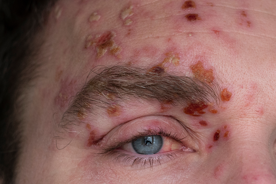 shingles4.png